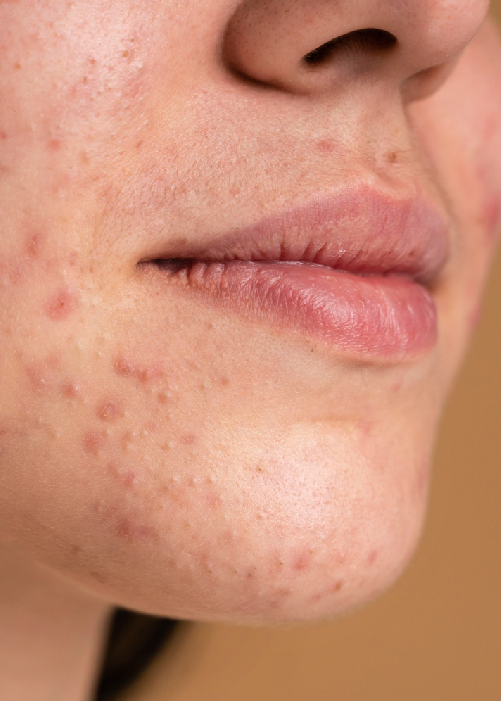 Professionelle Aknebehandlung München Ihre Haut in besten Händen