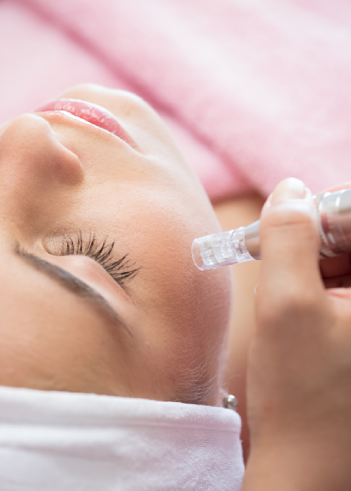 Microneedling mit Radiofrequenz (RF) in München