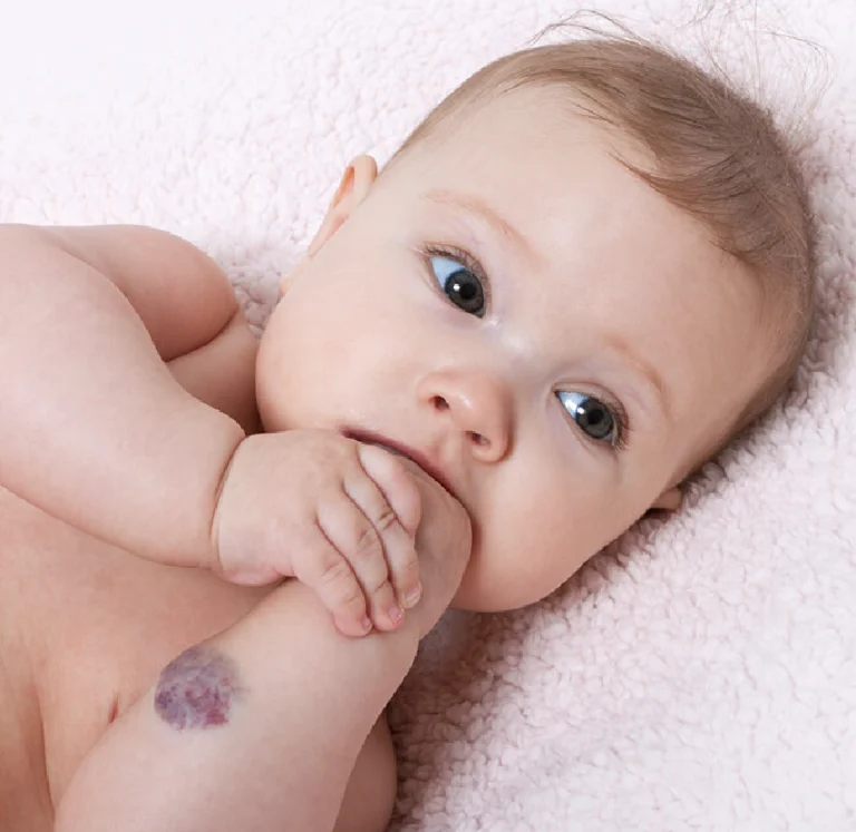 Blutschwämmchen & Feuermale entfernen in München